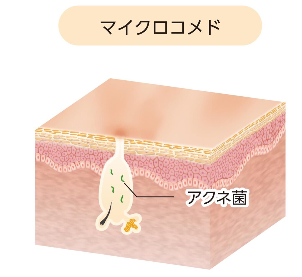 マイクロコメド