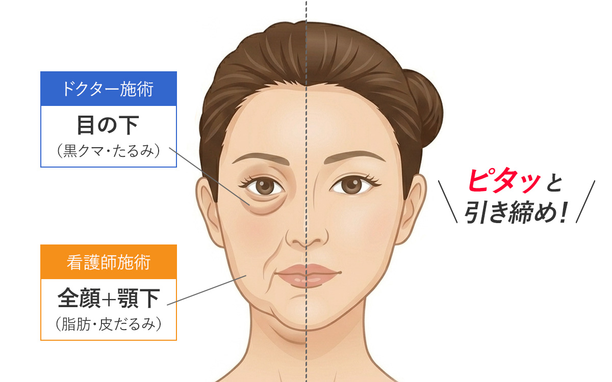 モフィウス8の施術可能部位