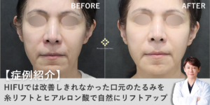 【症例紹介】HIFUでは改善しきれなかった口元のたるみを糸リフトとヒアルロン酸で自然にリフトアップ