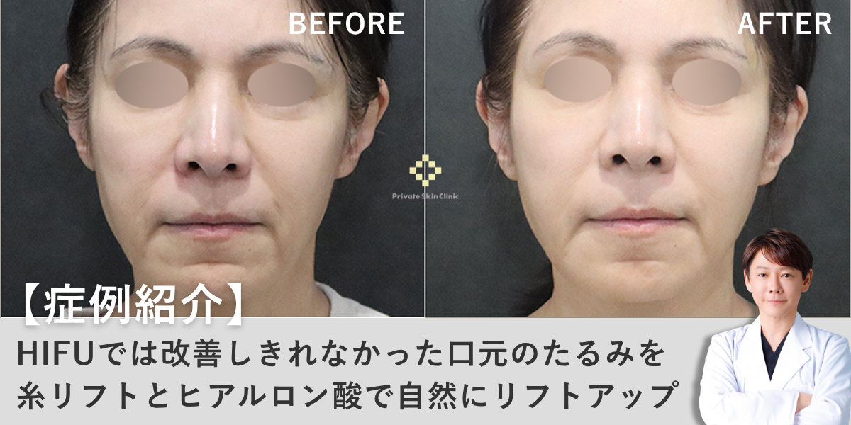 【症例紹介】HIFUでは改善しきれなかった口元のたるみ。糸リフトとヒアルロン酸で自然にリフトアップ