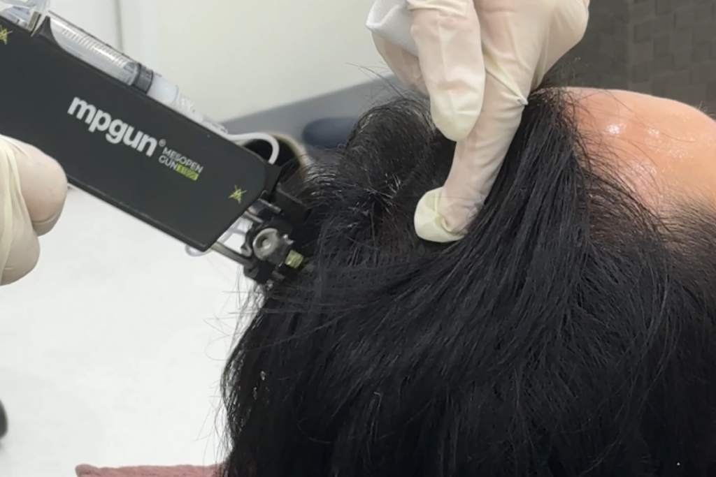MPガンによる毛髪再生医療