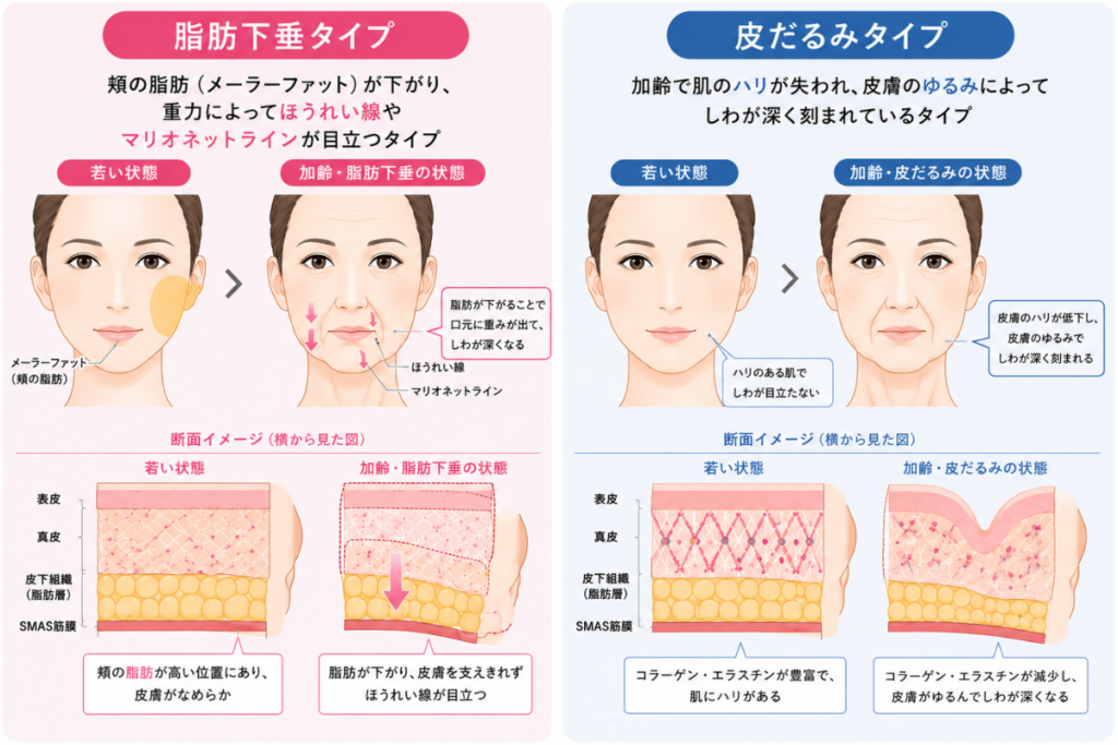 脂肪下垂タイプ・皮だるみタイプのほうれい線