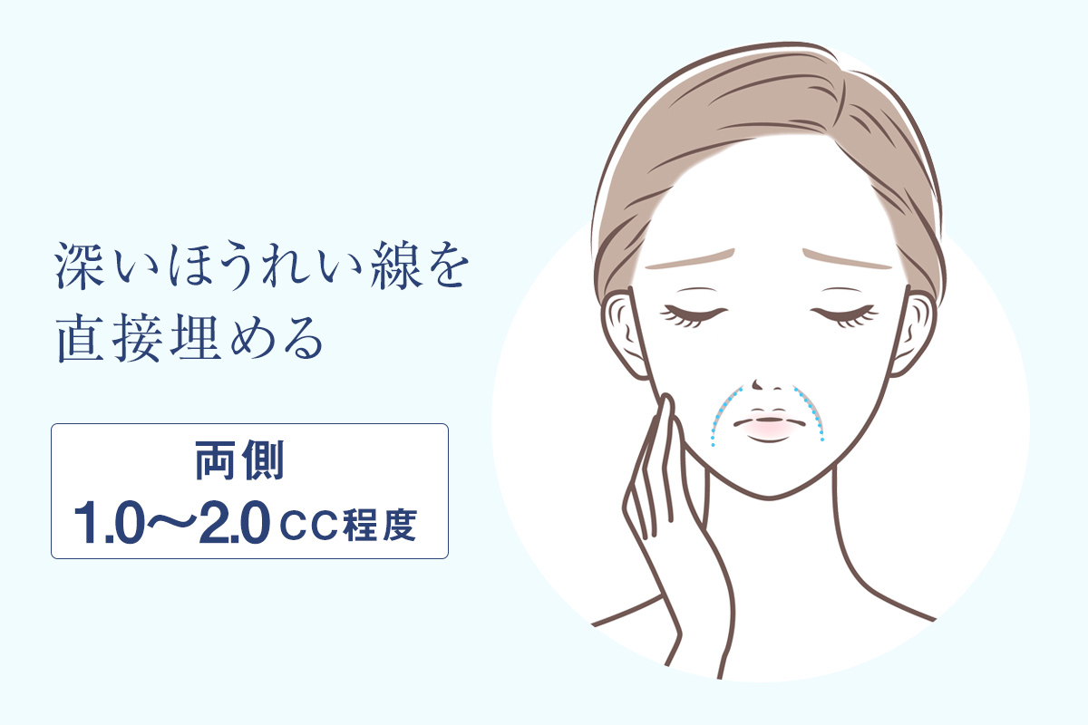 ほうれい線のヒアルロン酸注入量の目安・深いほうれい線を直接埋める（両側1.0～2.0cc）