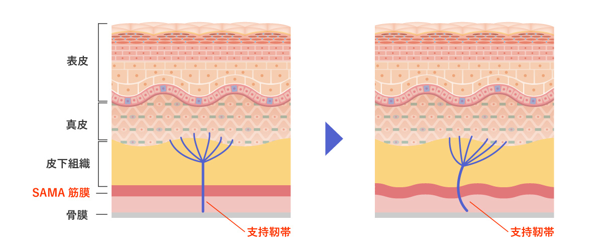 支持靭帯（リガメント）とSMAS筋膜のゆるみ