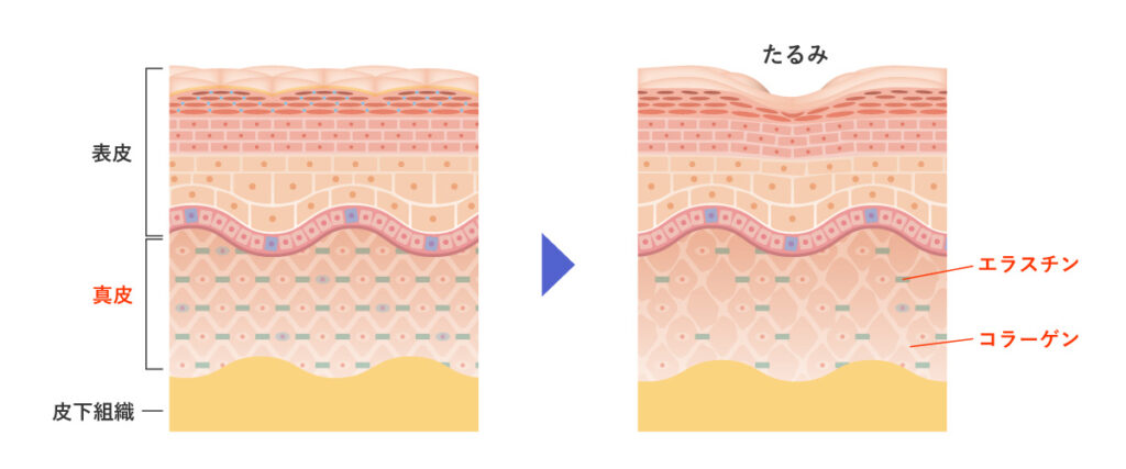コラーゲン・エラスチンの減少