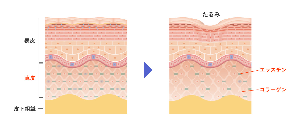コラーゲン・エラスチンの減少
