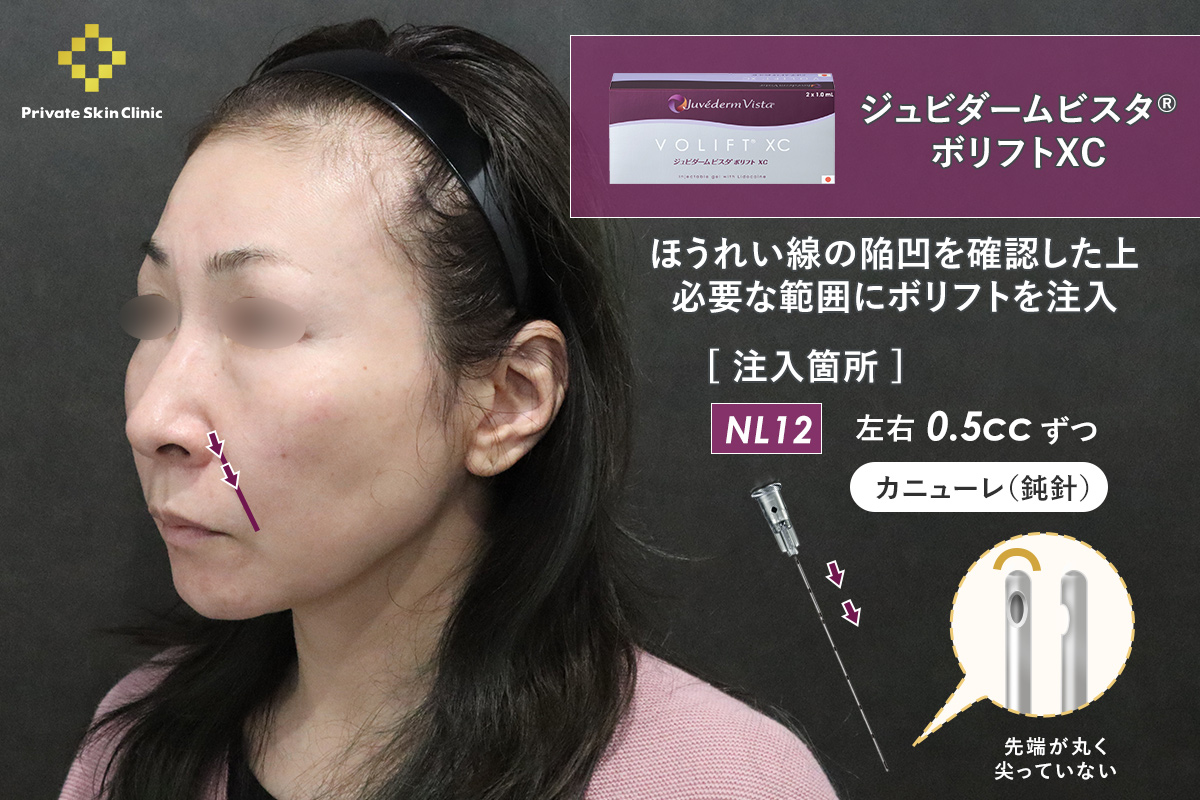 ほうれい線の陥凹｜ジュビダームビスタ® ボリフトXC