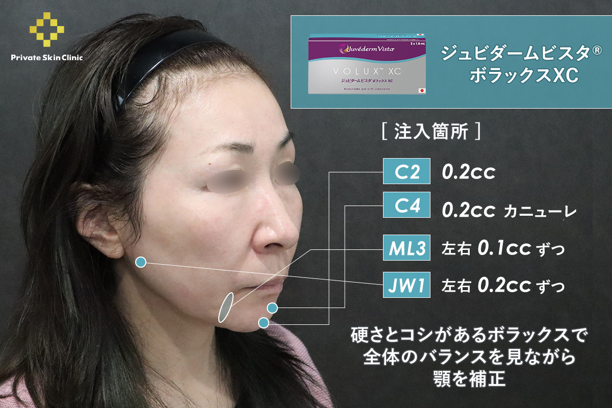 顎を自然に整える｜ジュビダームビスタ® ボラックスXC