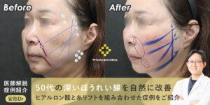 50代の深いほうれい線を自然に改善｜ヒアルロン酸と糸リフトを組み合わせた症例をご紹介