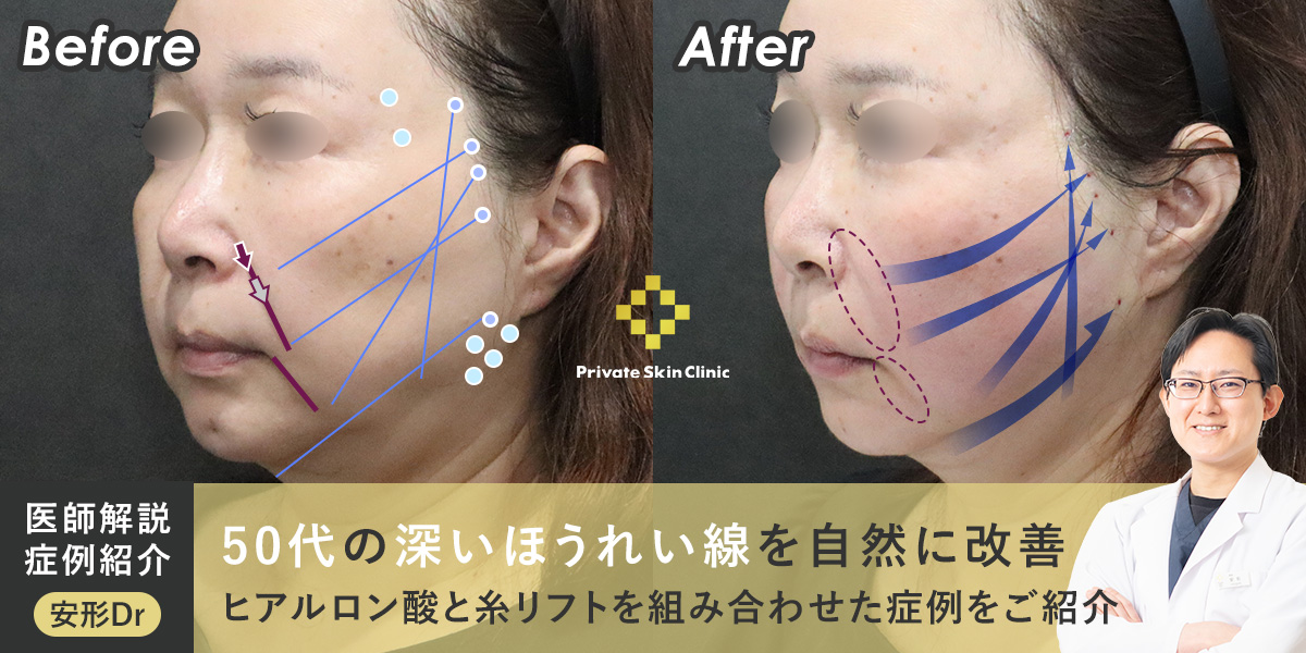 50代の深いほうれい線を自然に改善｜ヒアルロン酸と糸リフトを組み合わせた症例をご紹介