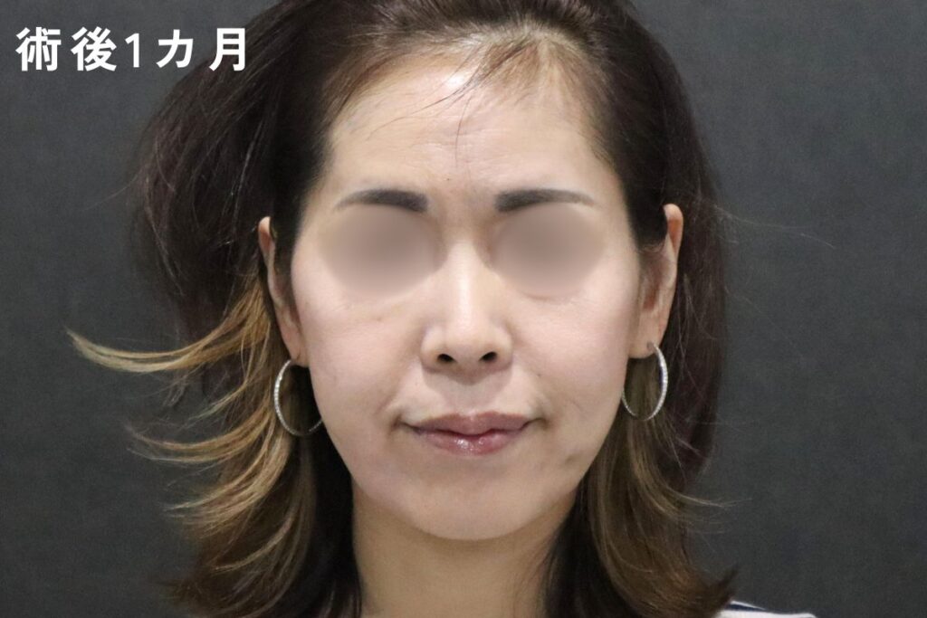 術後1カ月