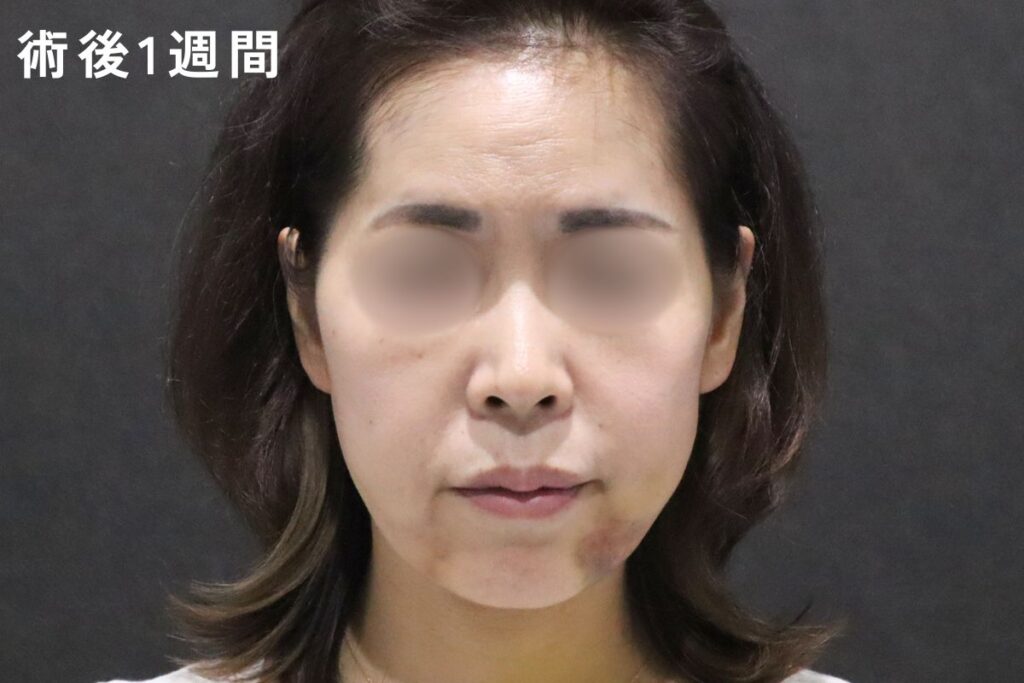 術後1週間