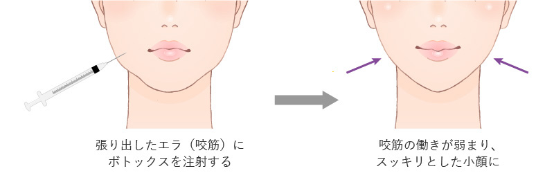 ボトックスをエラ（咬筋）に注射することによる小顔効果