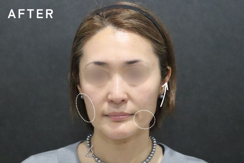ヒアルロン酸リフトの術後写真