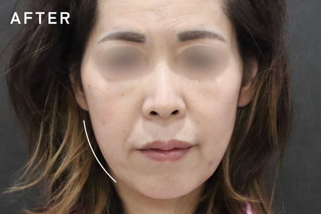 術後写真