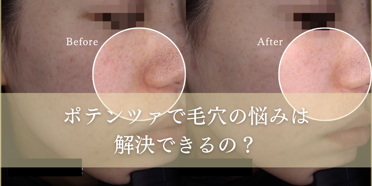 ポテンツァで毛穴の悩みは解決できるの?