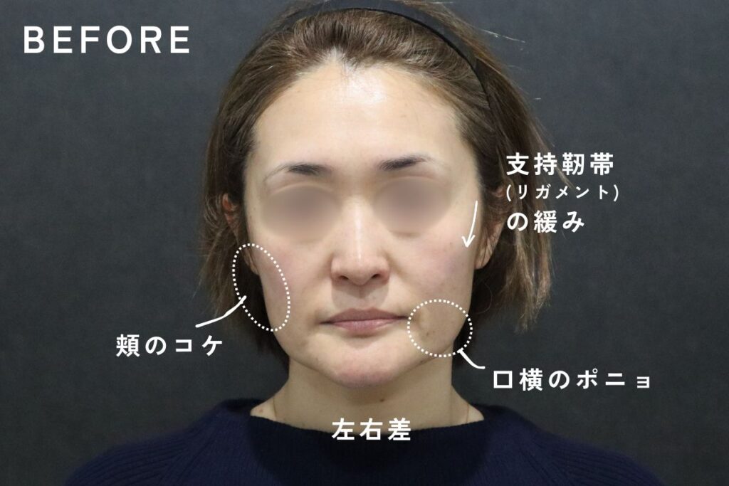 ヒアルロン酸リフトの術前写真