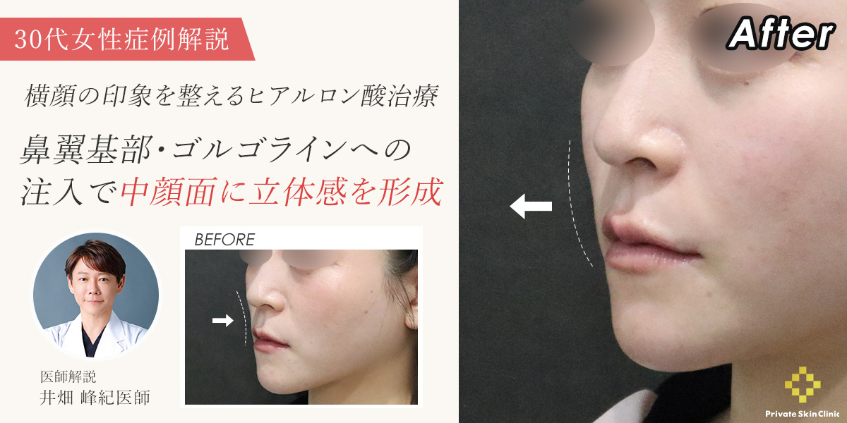 【症例解説】横顔の印象を整えるヒアルロン酸治療|鼻翼基部・ゴルゴラインへの注入で中顔面に立体感を形成