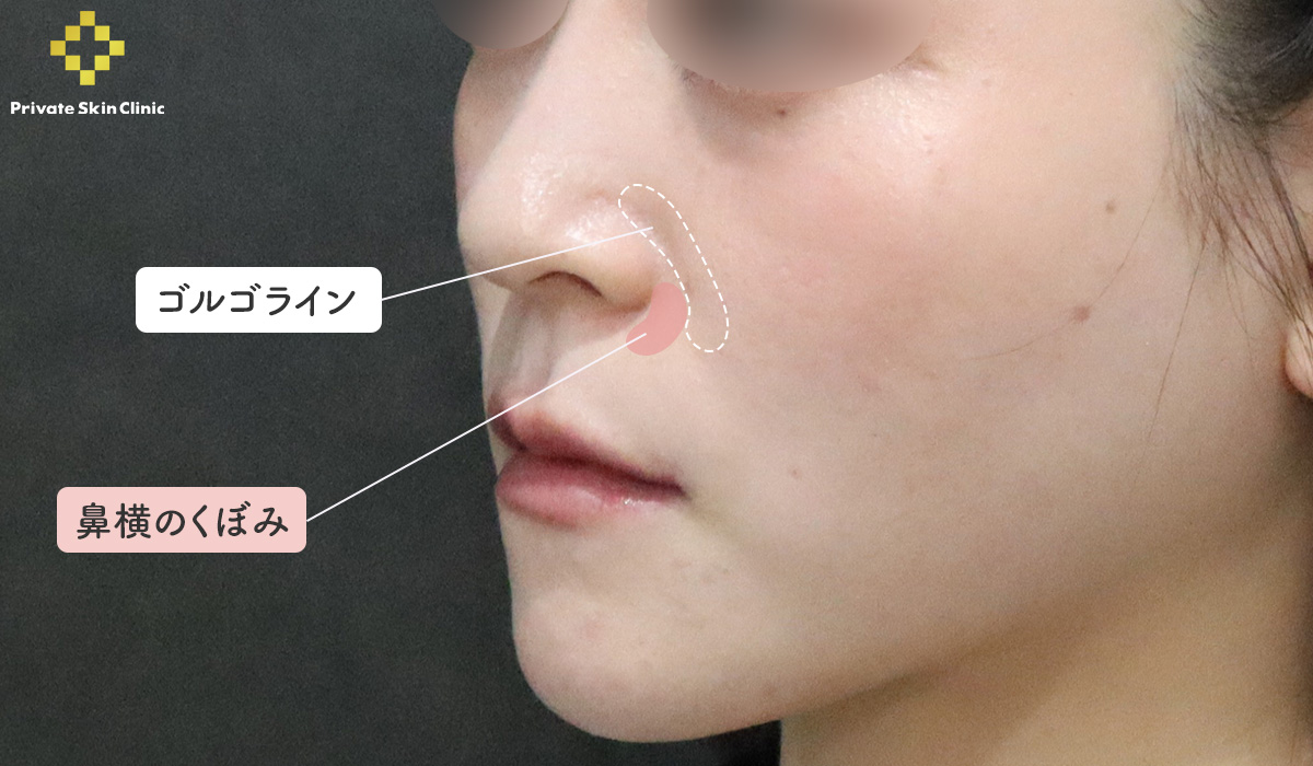 患者様のお悩み（鼻横のくぼみとゴルゴライン）