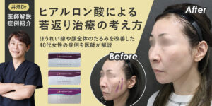 ヒアルロン酸による若返り治療の考え方｜ほうれい線や顔全体のたるみを改善した40代女性の症例を医師が解説