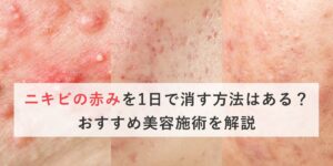 ニキビの赤みを1日で消す方法はある？