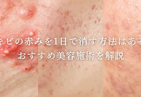 ニキビの赤みを1日で消す方法はある？