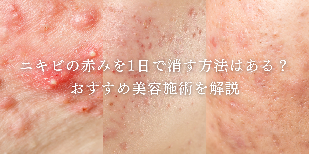 ニキビの赤みを1日で消す方法はある？