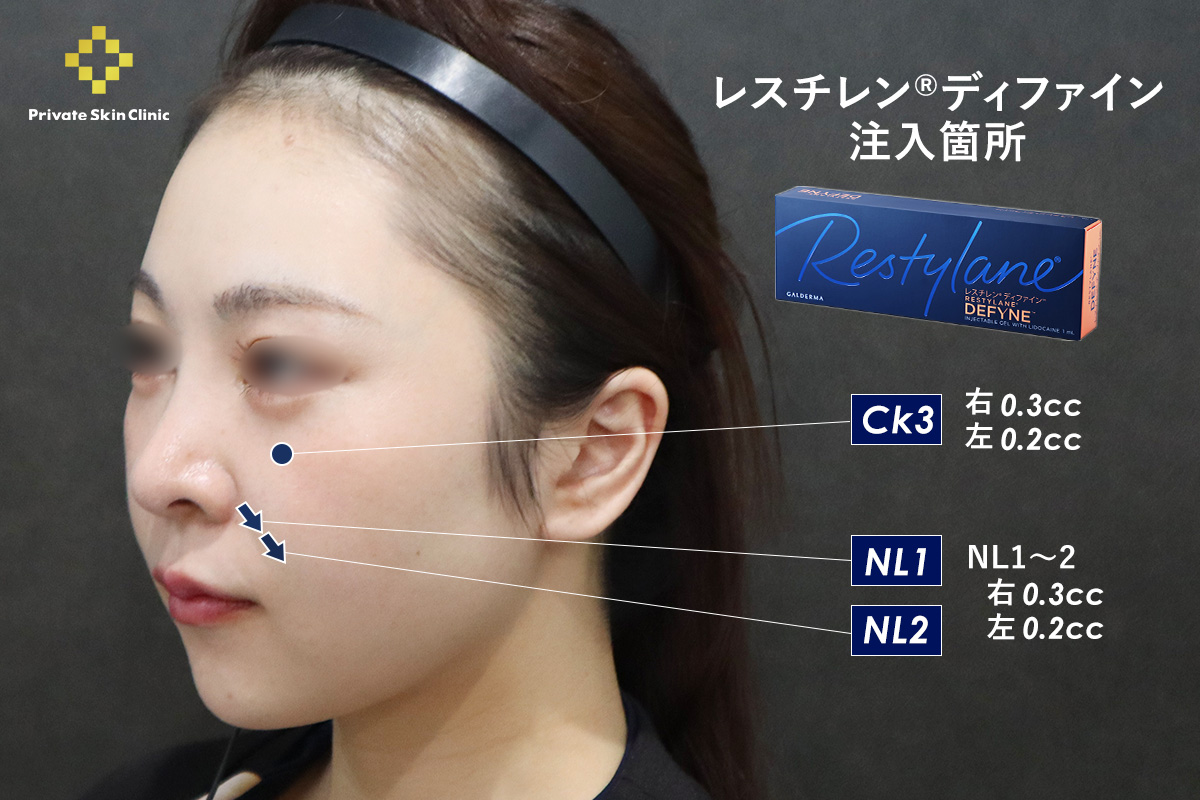 レスチレン®ディファインの注入場所　Ck3：右0.3cc・左0.2cc/NL1〜2：右0.3cc・左0.2cc
