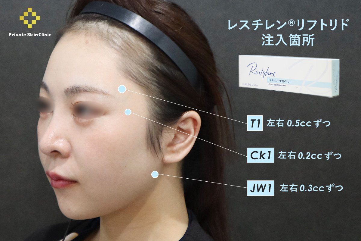 レスチレン®リフトリドの注入場所T1（こめかみ）：左右0.5ccずつ/Ck1（頬骨弓）：左右0.2ccずつ/Jw1（下顎）：左右0.3ccずつ
