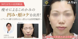 【症例解説】痩せによるこめかみの凹み・頬コケを改善｜ヒアルロン酸で凸凹のない滑らかな逆卵型輪郭へ