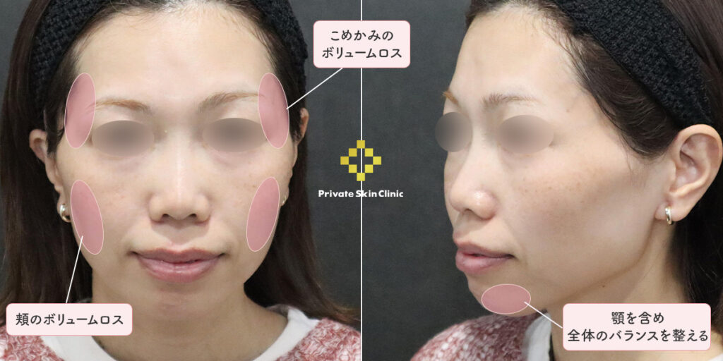 痩せによる輪郭変化「ピーナッツ顔」をヒアルロン酸で整えた30代女性