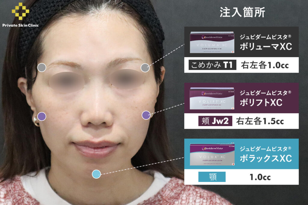 痩せによるボリュームロスに対して行ったヒアルロン酸治療の注入箇所