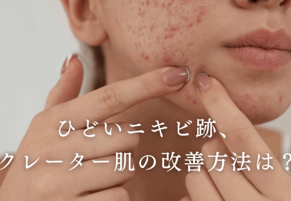 ひどいニキビ跡やクレーター肌の改善方法について