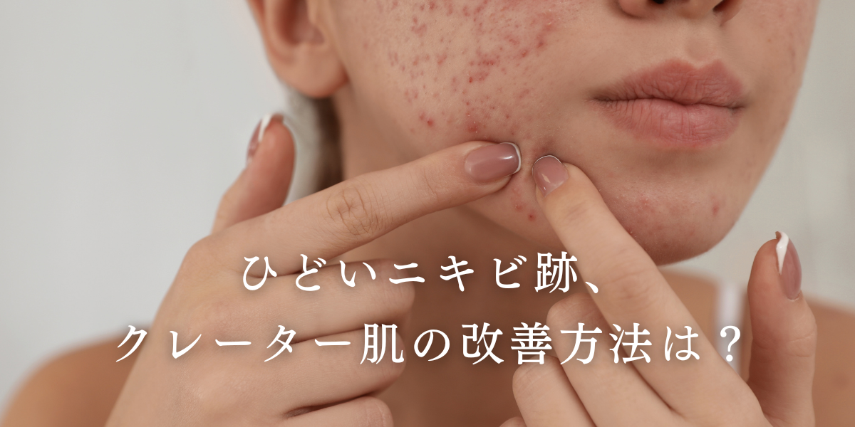 ひどいニキビ跡やクレーター肌の改善方法について