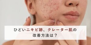 ひどいニキビ跡、クレーター肌の改善方法は？