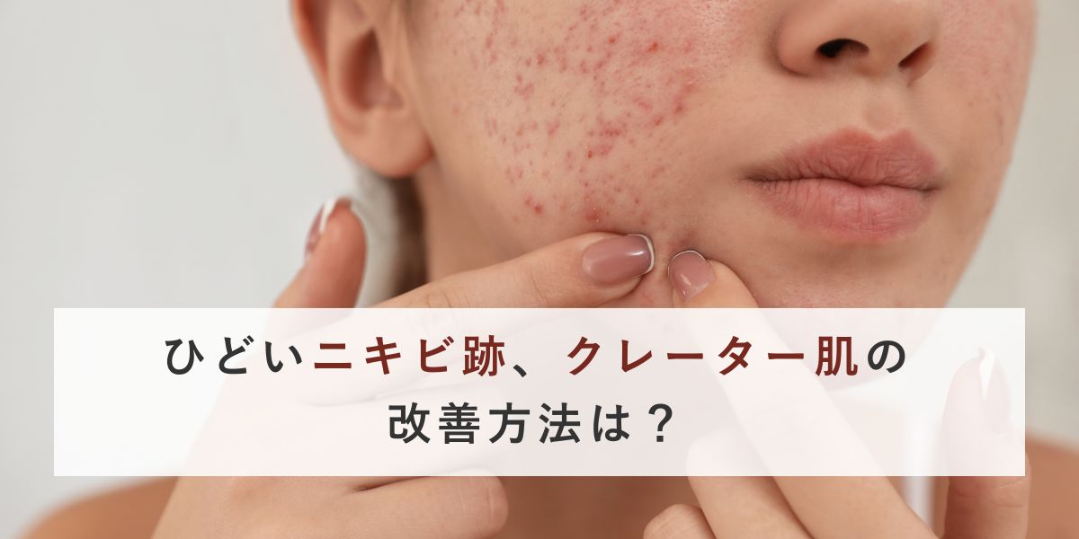 ひどいニキビ跡、クレーター肌の改善方法は？