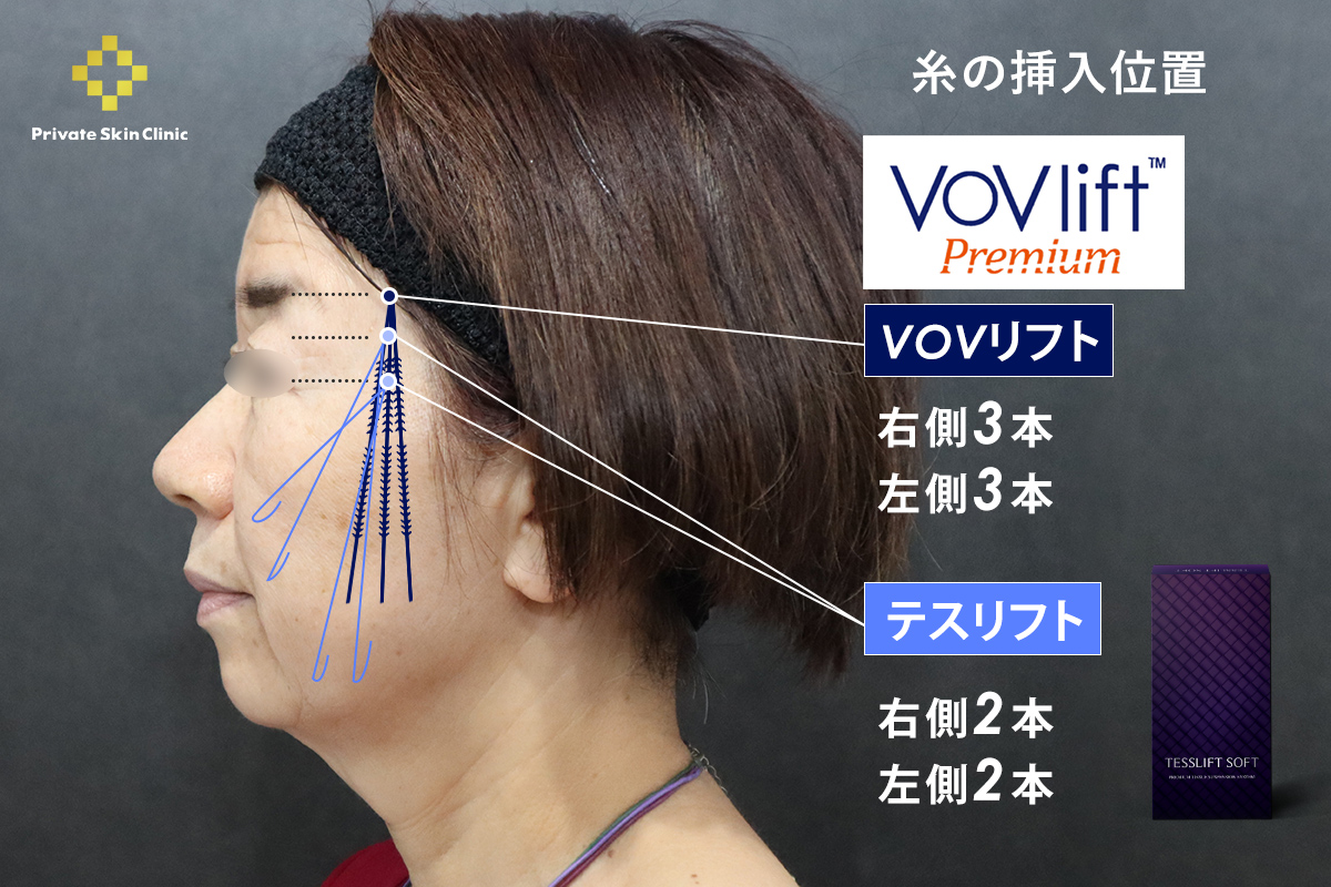 VOV lift™とテスリフトの糸の挿入位置