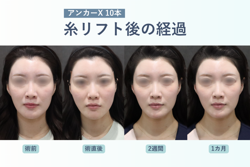 糸リフトの術後経過とダウンタイム