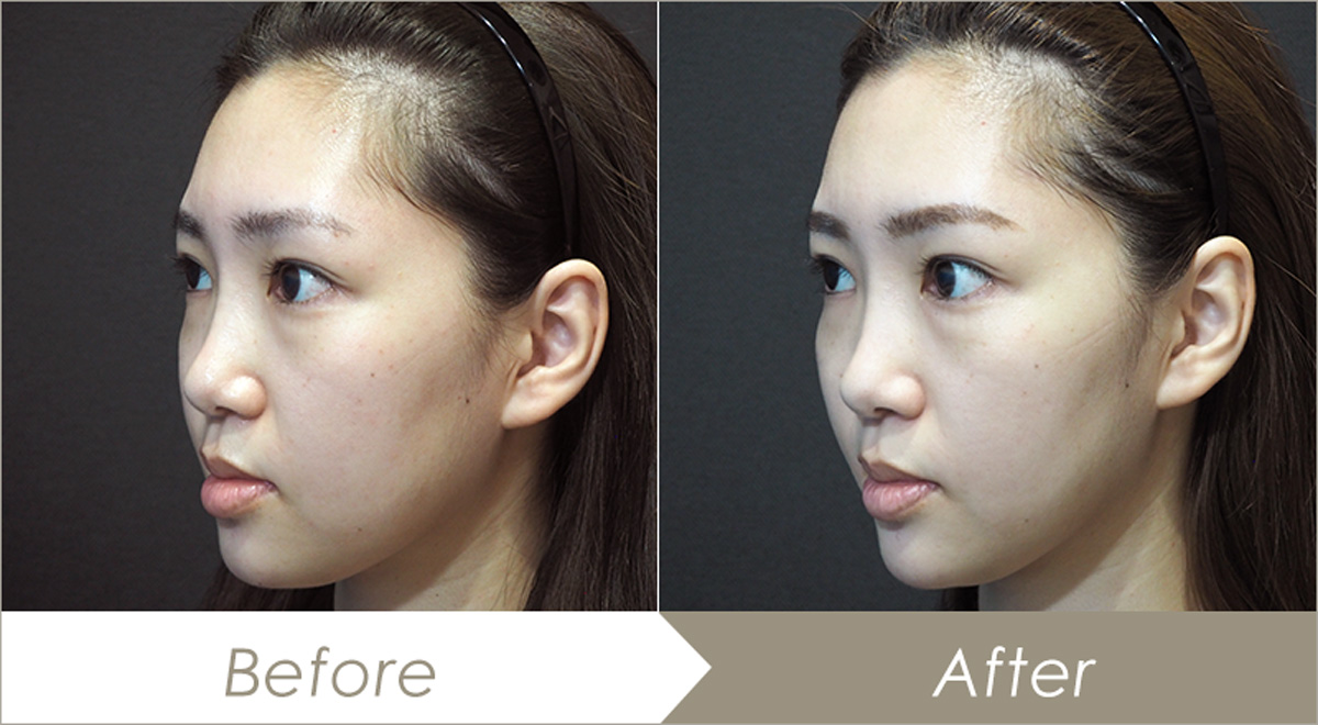 糸リフト（スレッドリフト）の施術例（Gコグリフト6本）-症例写真