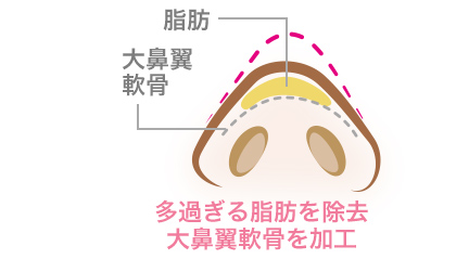 鼻尖形成術（鼻尖縮小術）