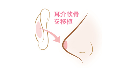 耳介軟骨移植（鼻）