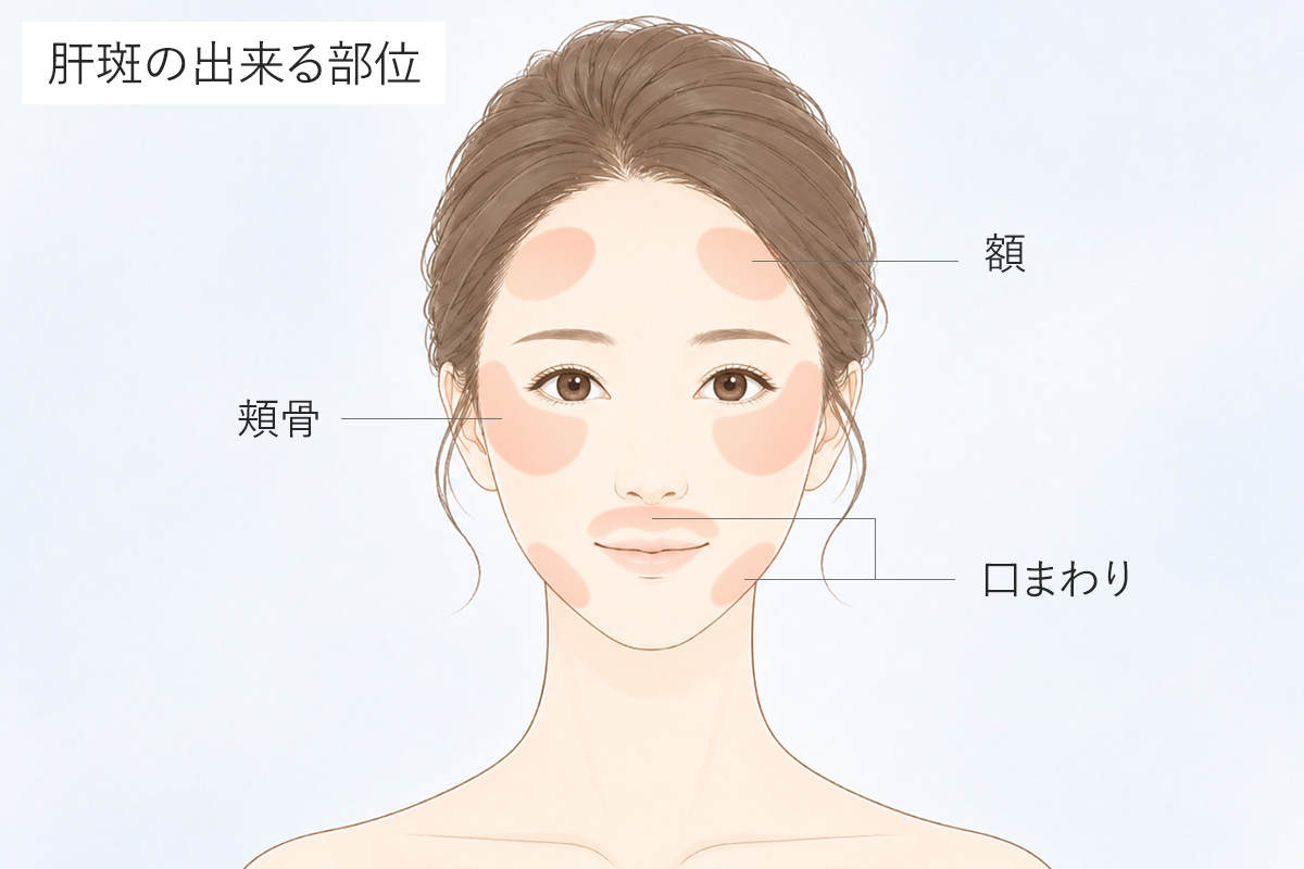 肝斑の出来る部位