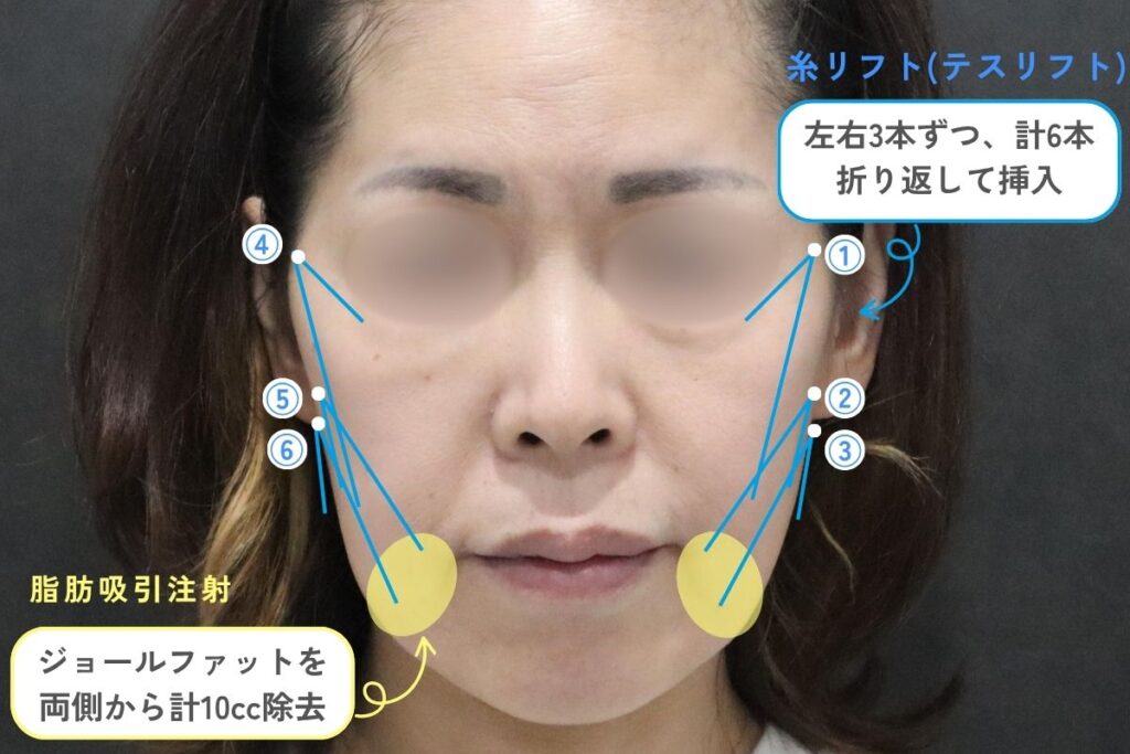 施術の詳細