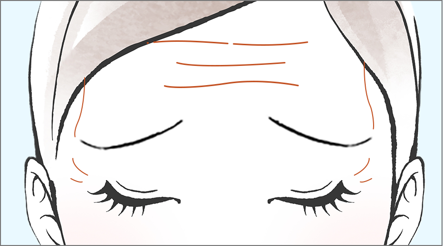 額（おでこ）のシワを改善・丸みのある若々しいおでこに