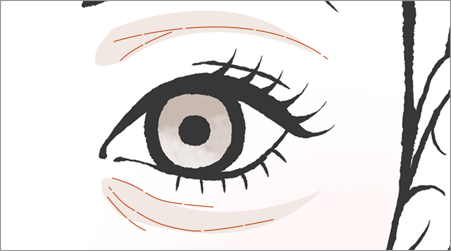 くぼんだ目の上、目の下に注入し、健康的な目元に