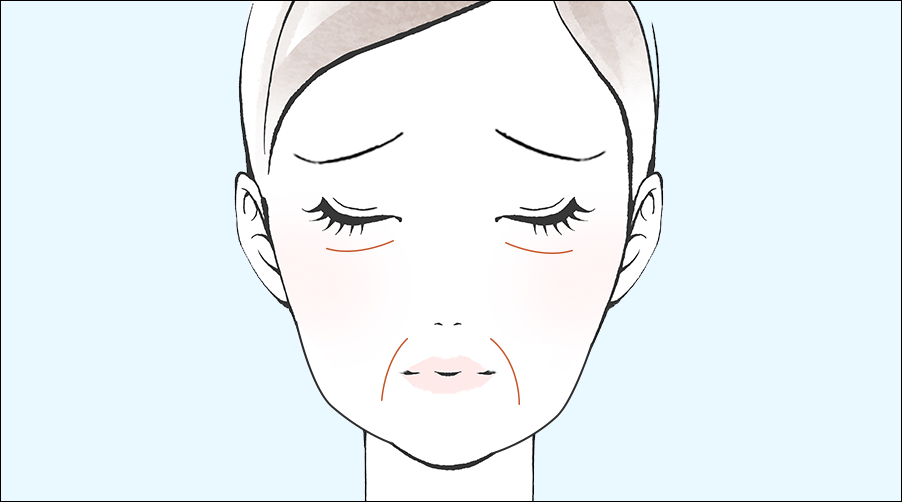 ヒアルロン酸リフト（支持靭帯）