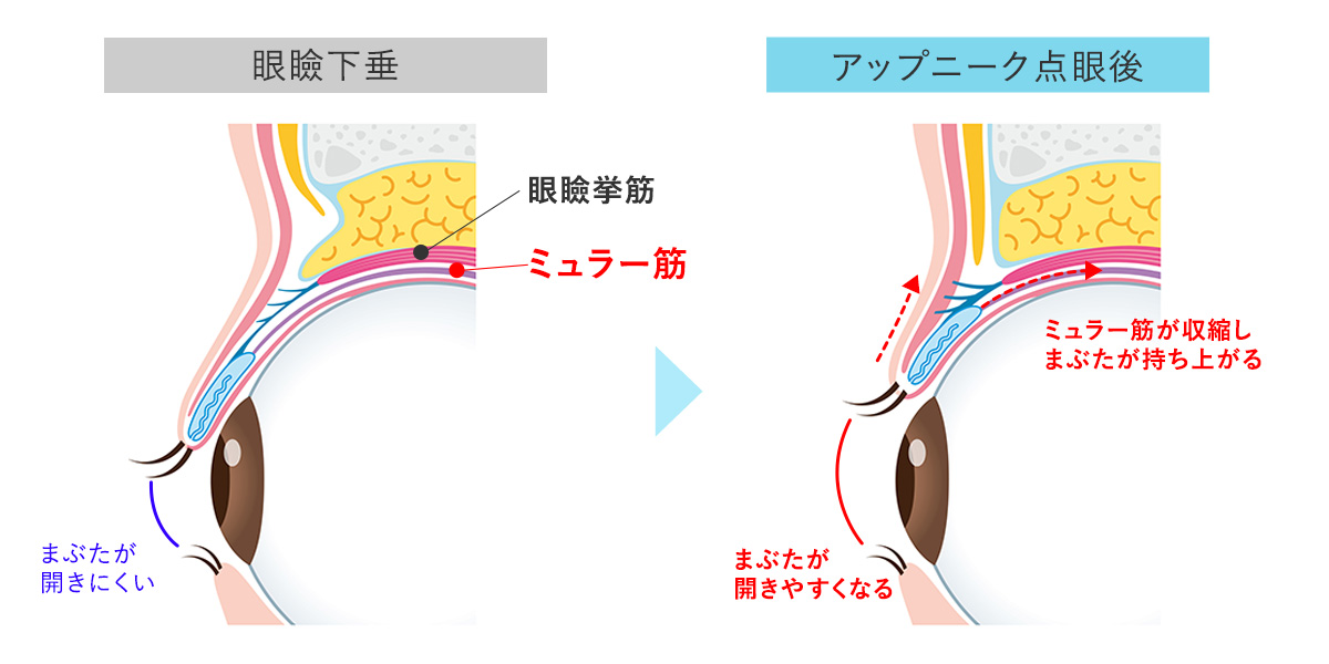 アップニークはミュラー筋にはたらきかけ、筋肉が縮むことでまぶたが持ち上がる