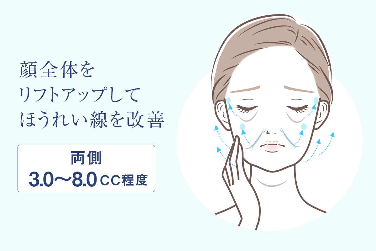 ほうれい線のヒアルロン酸注入量の目安・顔全体をリフトアップしてほうれい線を改善（両側3.0～8.0cc）