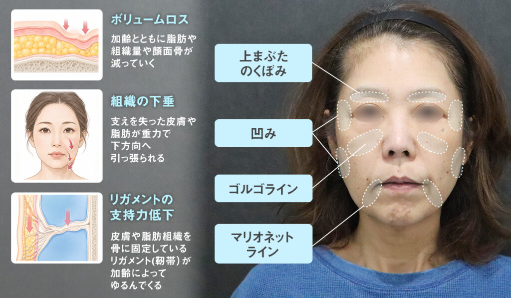 顔全体のたるみがお悩みの50代女性